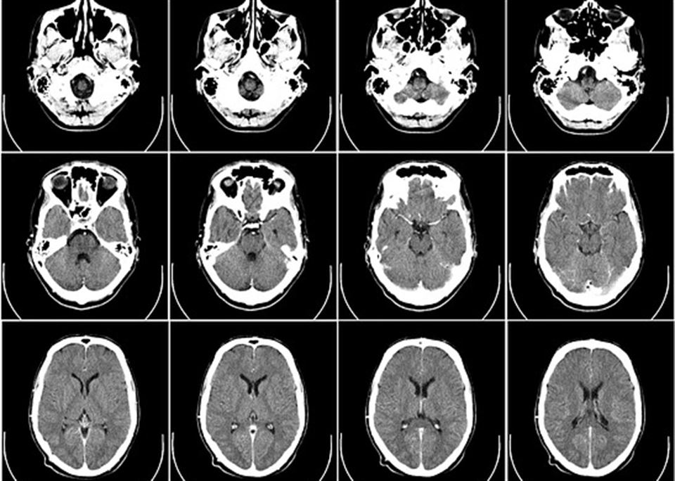 cerebro garuna alzheimer tomografia