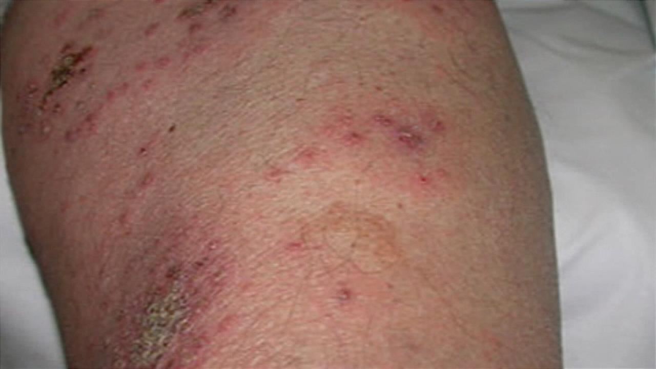 sarna-escabiosis-eitb_1280x720